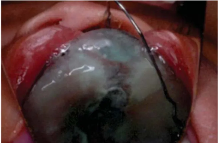 Figure 11. After palatal segments alignment and cleft 