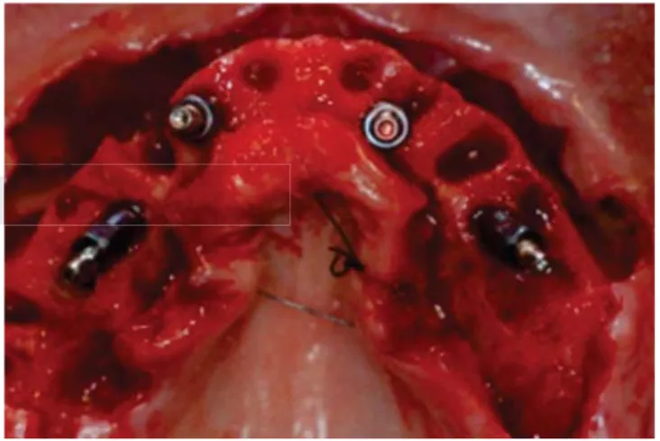 Figura 7. Guía quirúrgica colocada previsualizando la posi- posi-ción de los implantes.