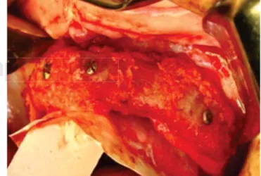 Figure 11. Donor site hemostasis.