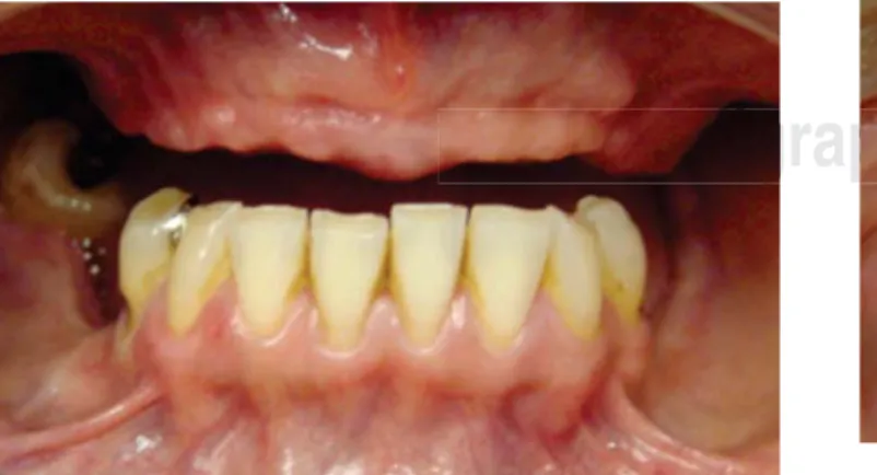Figure 21. Placement of fixed prosthesis supported by 