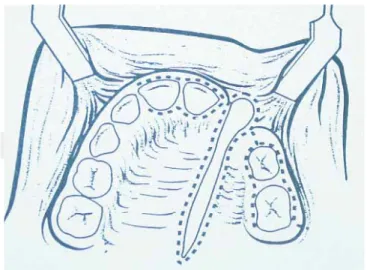 Figure 1. Schematic depiction of modifi cation of approach 