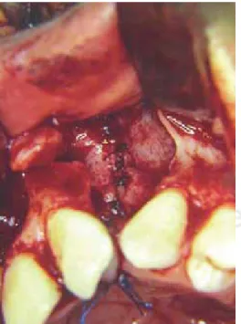 Figure 3. A suffi cient amount of bone tissue to be grafted 