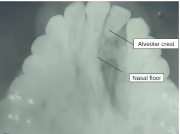 Figure 5. Radiographic image shows an example of Nasoal-
