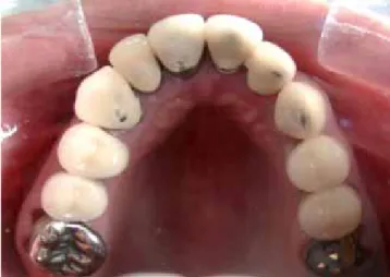 Figura 2. Vista oclusal inicial maxilar de la paciente.