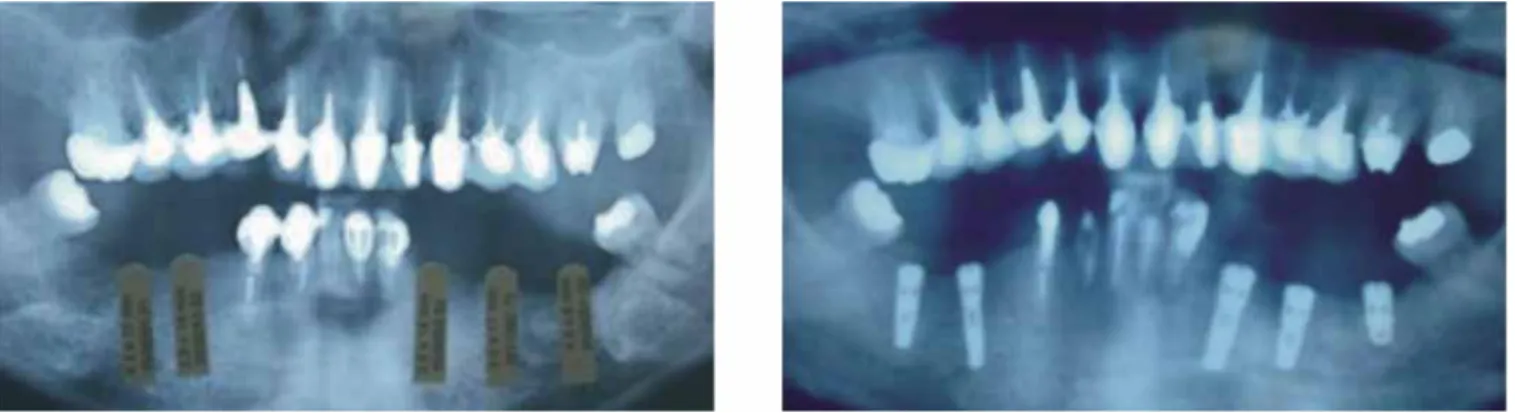 Figura 6. Ortopantomografías de implantes colocados.