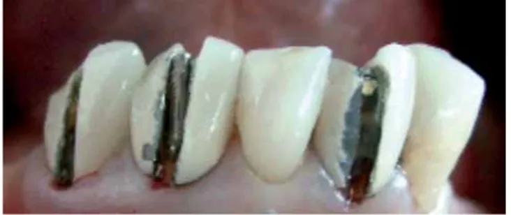 Figura 8. Retiro de coronas metal-porcelana en mandíbula.