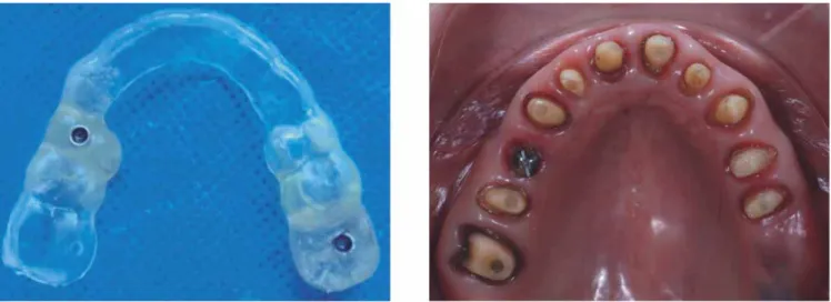 Figura 18. Prueba de cofi as en maxilar y estructuras metálicas en mandíbula.