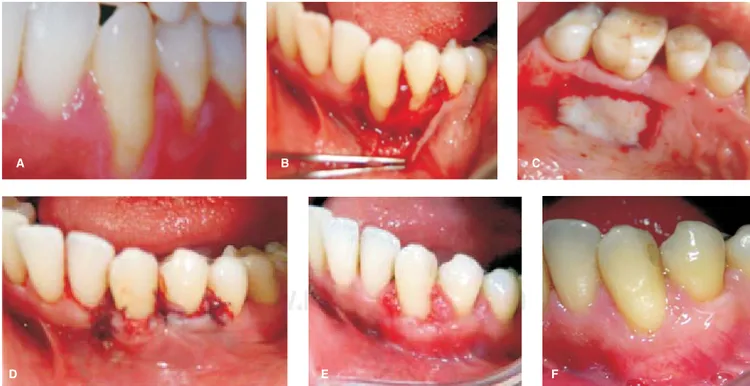 Figura 4. Fotografía clínica preoperatoria de los dientes 33-34 (A), zona receptora con elevación del colgajo de espesor