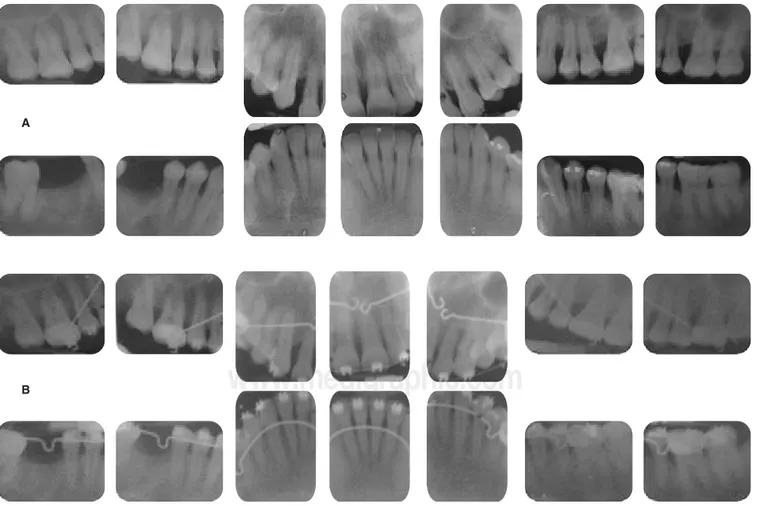 Cuadro II. Profundidad al sondeo inicial y 12 meses posterior al tratamiento periodontal.