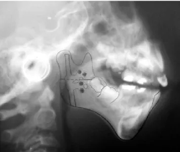 Figura 4. Osteotomía mandibular con colocación y activa-