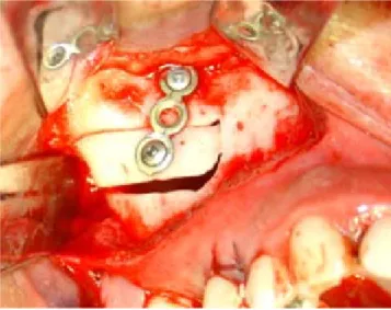 Figura 10.  Colocación de material de osteosíntesis.