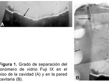 Figura 1. Grado de separación del ionómero de vidrio Fuji IX en el piso de la cavidad (A) y en la pared cavitaria (B).