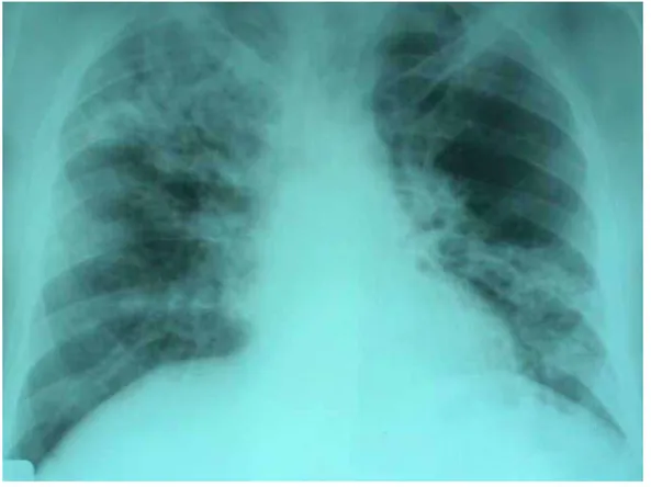Figura No. 4. Radiografía de tórax mostrando afección en los tres niveles en un paciente masculino de 50  años.