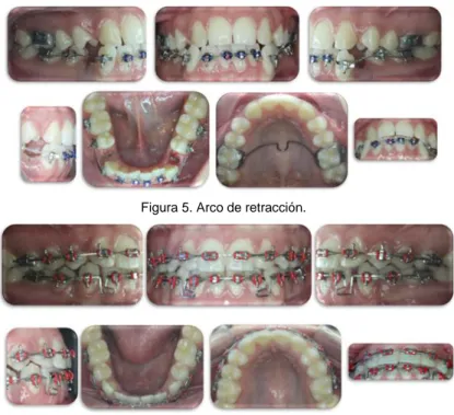Figura 4. Fotografías intraorales después de la colocación de  brackets en  los dientes mandibulares