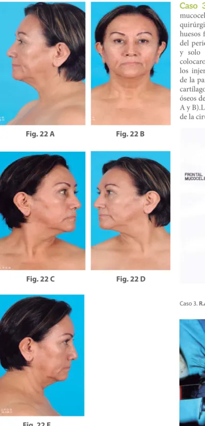 Fig. 22 A Fig. 22 B