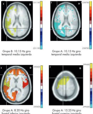 Figura 1. Imágenes representativas de los cambios observados en las  fuentes del EEG pre-post tratamiento