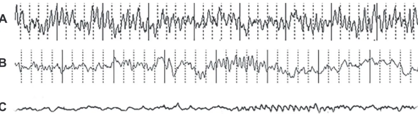 Figure 5. Comparison of Mu rhythm features observed.