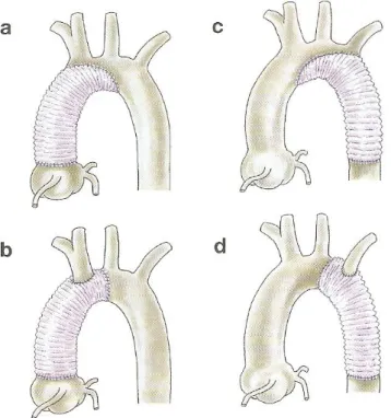 Figura 1.5 Técnica de sustitución de diferentes tramos de la aorta con una prótesis o graft