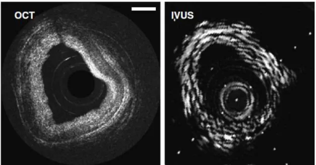 Figura  3.2  Comparativa  entre  OCT  y  ultrasonidos  (IVUS,  IntraVascular  UltraSound)  en  una  arteria 