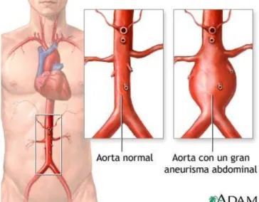 Figura 1.1 Representación de la aorta en el cuerpo humano y comparativa de una aorta abdominal 