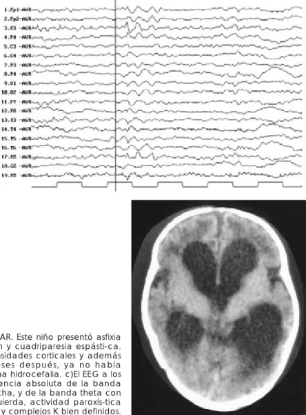 Fig. 3. Se exponen las TC evolutivas del caso MAR. Este niño presentó asfixia perinatal severa, con reflejos de hiperextensión y cuadriparesia espásti-ca