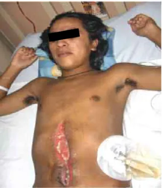 Figura 6. El paciente un día antes de su egreso, la herida se