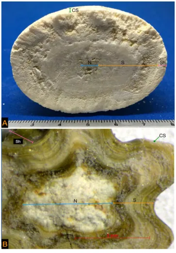 Figure 2. Internal structure of a urolith. N: nucleus or nidus, S: stone; Sh: shell; CS: crystals surface