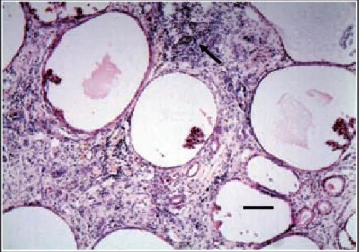 Figura 3:  Fotomicrografía del riñón de una perra de  raza Rottweiler,  que muestra fi brosis periglomerular, infi ltrado infl amatorio  inters-ticial (fl echa), dilatación marcada de los espacios de fi ltración  y  cápsulas de Bowman,  y ovillos glomerula