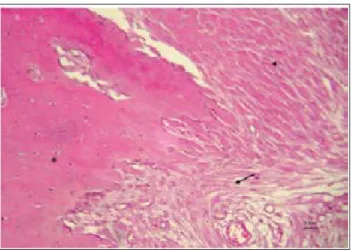 Figure 2:  Another area is presented, in which the fi brous connective  tissue (arrow) as well as the muscle fi bers (arrow heads), are  trans-formed into well differentiated osseous tissue, with osteoblasts and  osteoclasts (asterisk); H&amp;E (100X)
