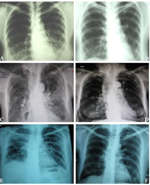 Figure 1. Chest X-ray of 3 patients. A and B: Chest X-ray of patient 1, December 2001 and  July 2003 before and 22 months after ganciclovir treatment end, respectively