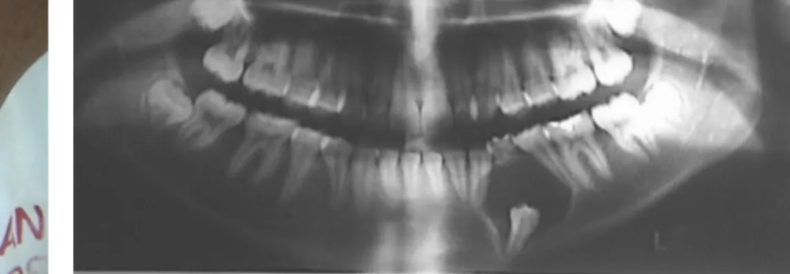 Figura 6. Vista radiográfica del quiste dentígero a nivel de 34Figura 5. Obsérvese la asimetría ocasionada 