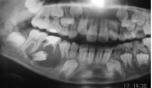 Figura 13. Obsérvese Quiste dentígero en la región del segundo molar temporal