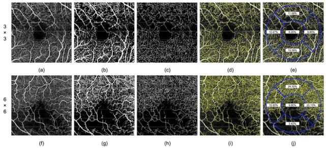 Figure 2. Steps of the automatic analysis of the optical coherence tomography angiography (OCTA) 3  × 3 and 6 × 6 mm images (a–e and f–j, respectively) using the proposed methodology