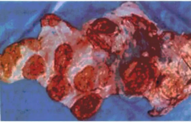 Figura 3. Edema y necrosis de los cotiledones por B. melitensis (http://osp.mans.edu.eg/elsawalhy/Inf-Dis/brucellosis.htm, 2010)