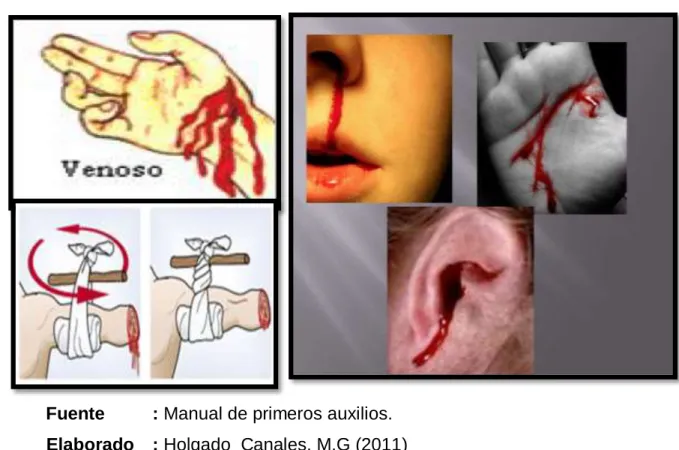 Figura N° 11: Imágenes de hemorragia: 