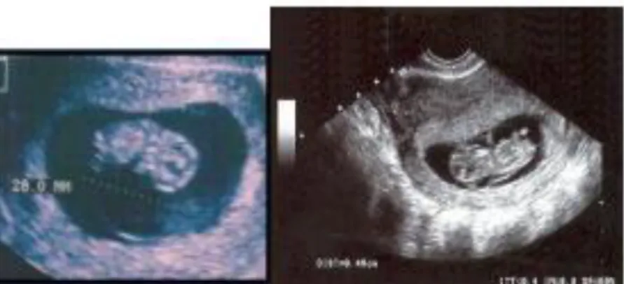 Figura 2 longitud embrionaria máxima (LEM) (vetex- nalga) 