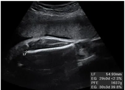 Fig. 1. Ecografía fetal que muestra la longitud del fémur fetal 