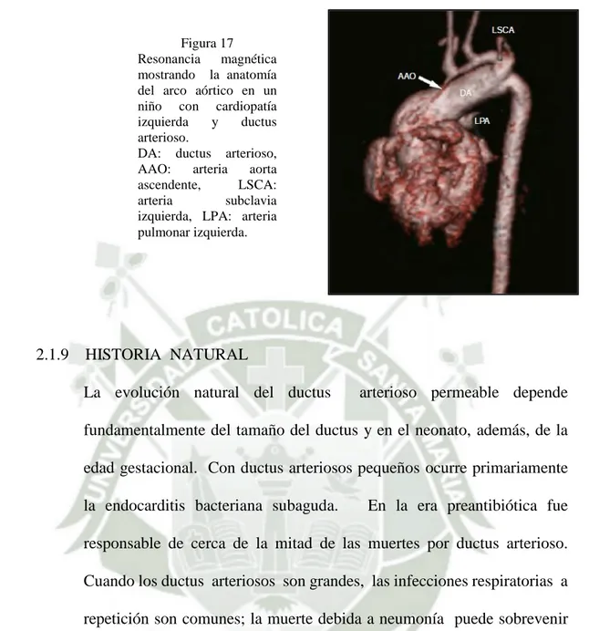 Figura 17  Resonancia  magnética   mostrando    la  anatomía  del  arco  aórtico  en  un  niño  con  cardiopatía  izquierda  y  ductus  arterioso