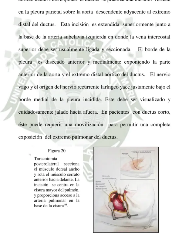 Figura 20  Toracotomía 