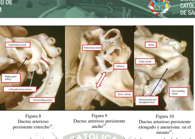 Figura 8  Ductus arterioso  persistente estrecho 37 . 