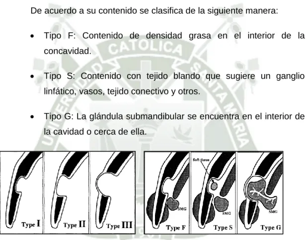 Figura 4: Tomado de Ariji y Cols. Stafne’s bone  cavity classification  based on  outline  and   content  determined  by  computed  tomography