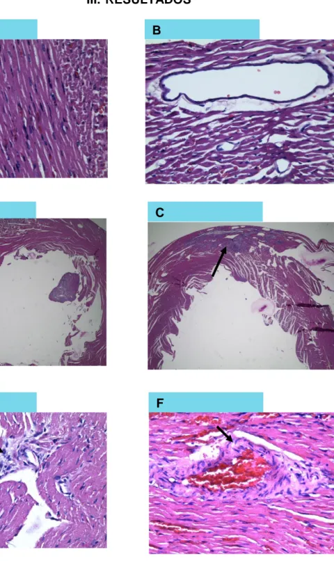 Fig 1. Tejido cardiaco de ratas Holtzman, en A) y B) sin endocarditis infecciosa a 10X, y  en C) y D) con endocarditis infecciosa a 10X (la flecha indica infiltración de células de  defensa en color azul) y en E) y F) se observan los cuerpos de Aschoff, (l