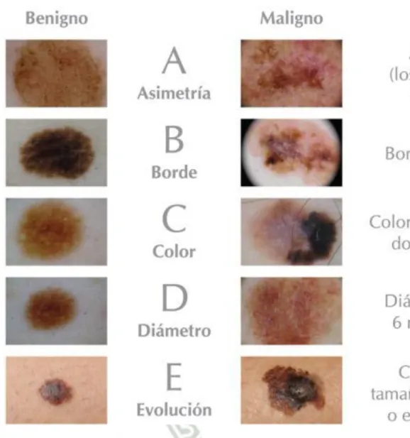 Figura 10. El ABCDE para detectar un melanoma (39) 