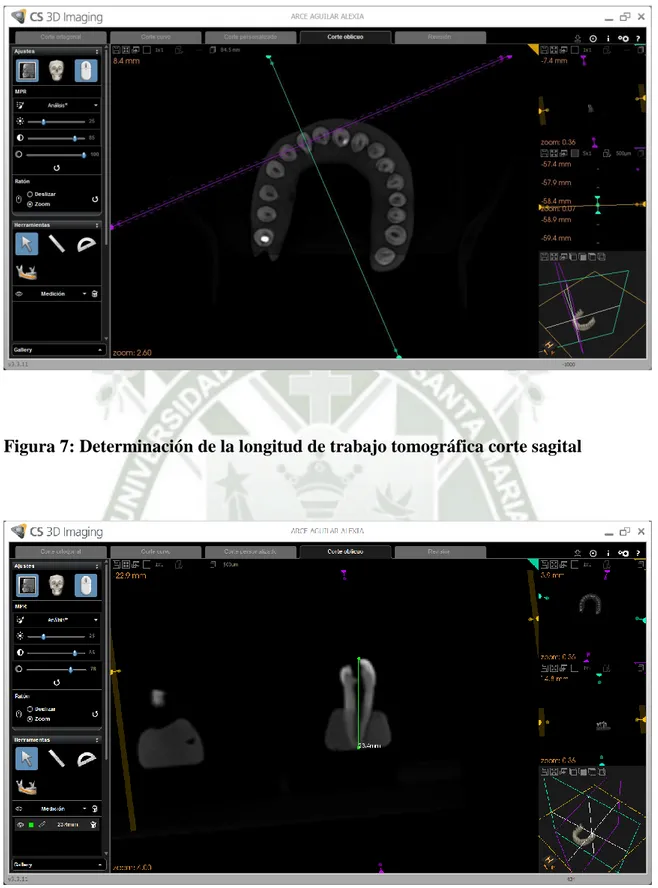 Figura 7: Determinación de la longitud de trabajo tomográfica corte sagital 