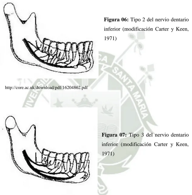 Figura 06: Tipo 2 del nervio dentario  inferior  (modificación  Carter  y  Keen,  1971) 