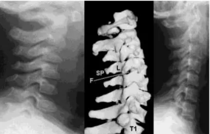 Figura  4.-  esquema  de  una  vértebra  y  situación  del  saco dural. 