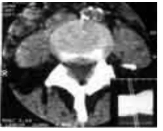 Fig.  4.-  TAC  lumbar  con  hernia  foraminal 