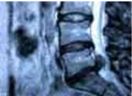 Fig. 6.- RM de columna lumbar. Se observa el disco herniado y emigrado  superiormente 
