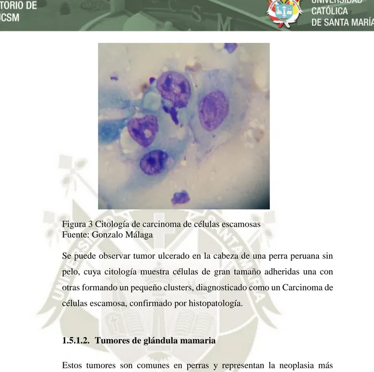 Figura 3 Citología de carcinoma de células escamosas   Fuente: Gonzalo Málaga 