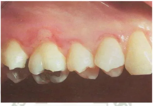 Foto  1: Recesión gingival leve en premolar y molares del lado derecho del maxilar  superior, subsecuente a cepillado horizontal traumático en paciente zurdo
